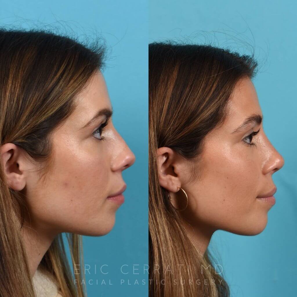 Female patient before and after rhinoplasty