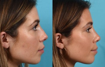 Female patient before and after rhinoplasty