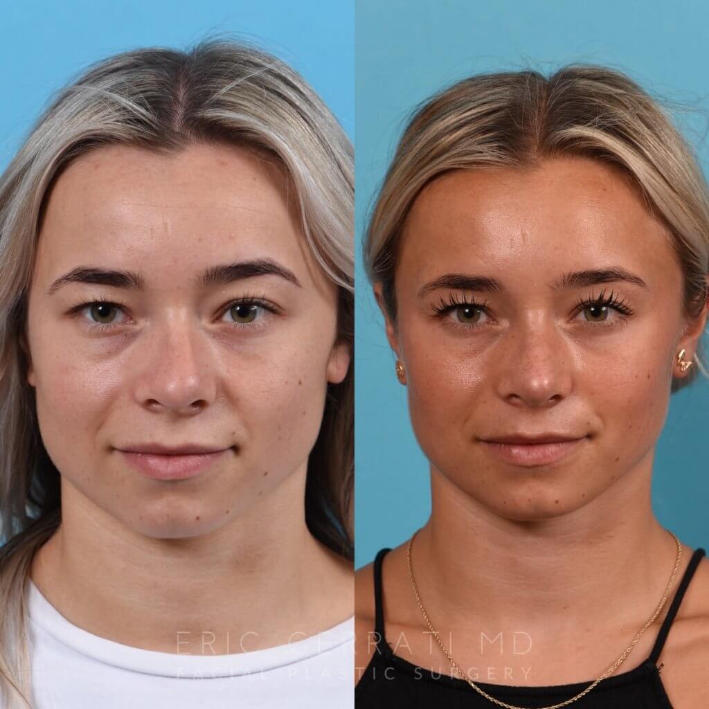 Female patient before and after rhinoplasty - front