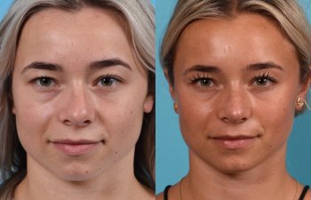 Female patient before and after rhinoplasty - front