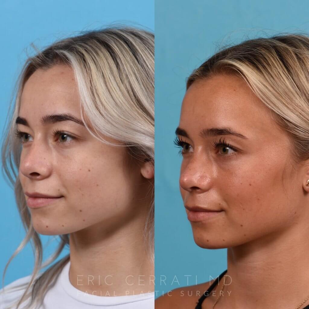 Female patient before and after rhinoplasty - left side