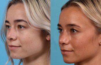Female patient before and after rhinoplasty - left side