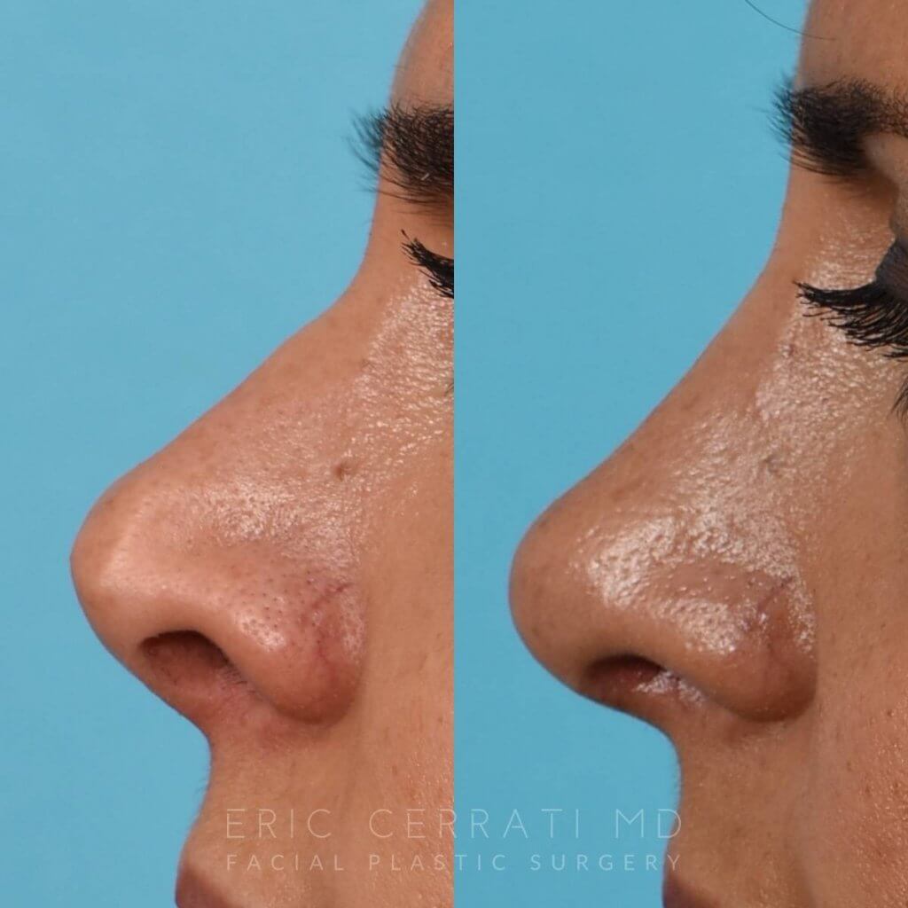 Female Patient Before and After Rhinoplasty