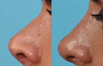 Female Patient Before and After Rhinoplasty