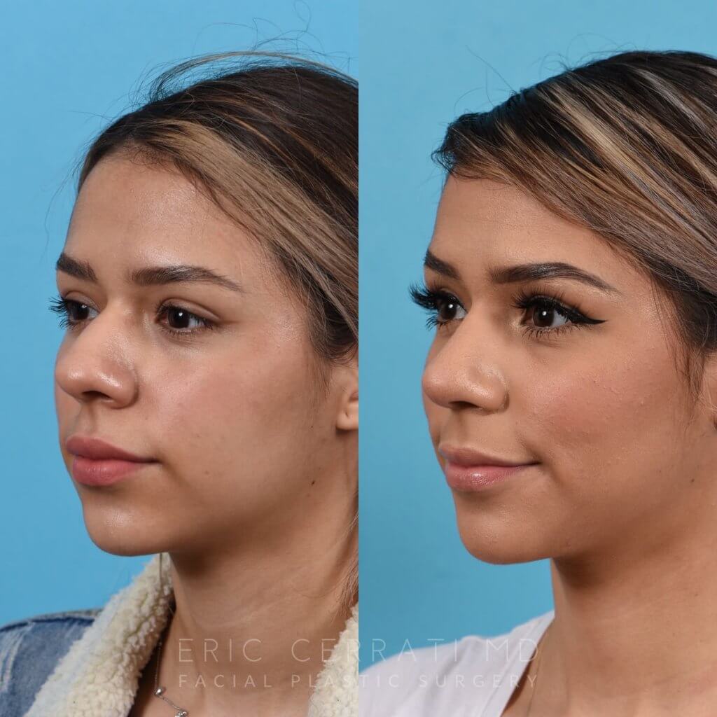 Female patient before and after rhinoplasty - left side