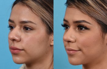 Female patient before and after rhinoplasty - left side