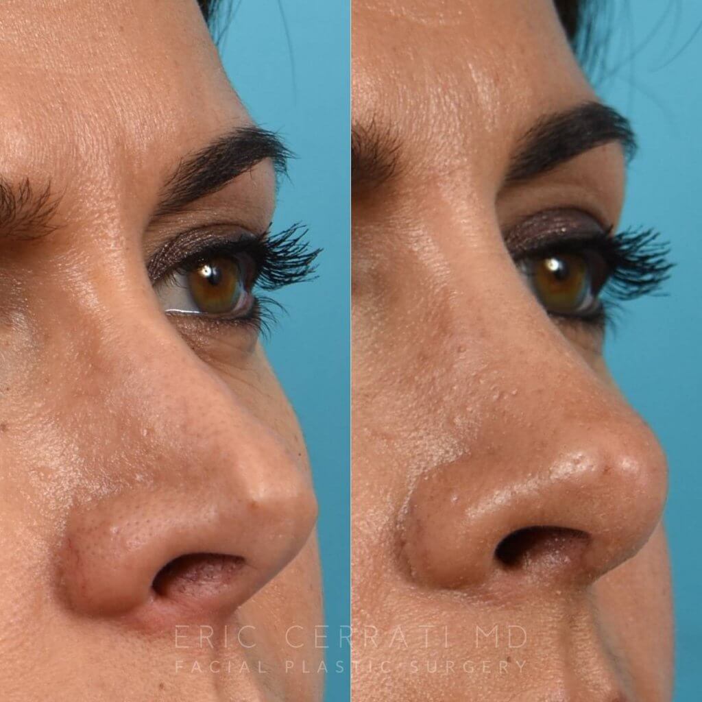 Female Patient Before and After Rhinoplasty