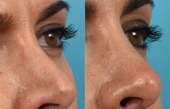 Female Patient Before and After Rhinoplasty