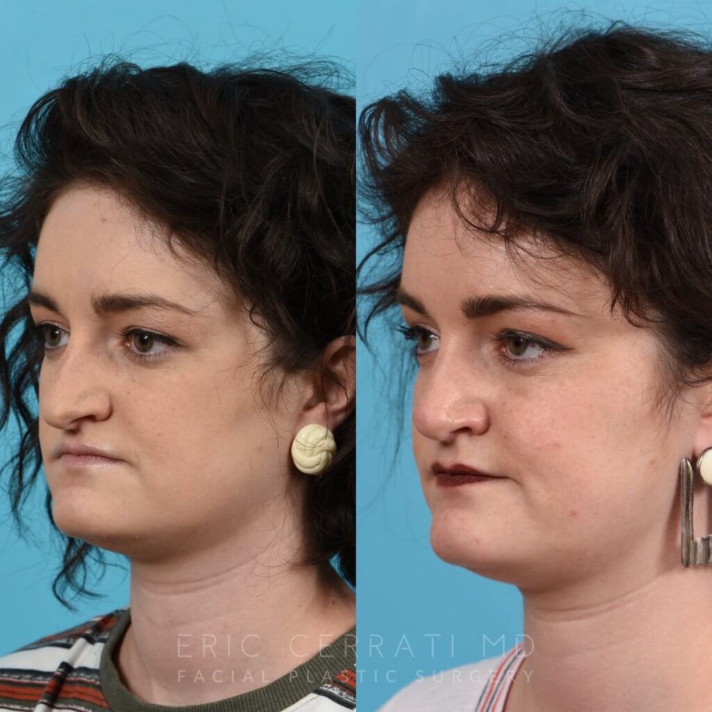 Female patient before and after rhinoplasty - left side