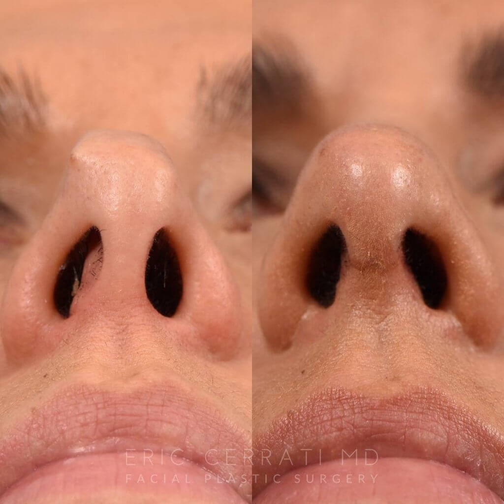 Female Patient Before and After Rhinoplasty