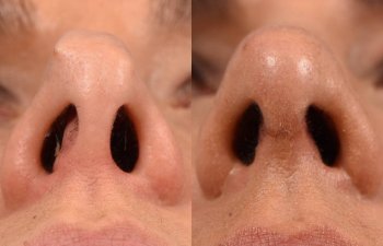 Female Patient Before and After Rhinoplasty