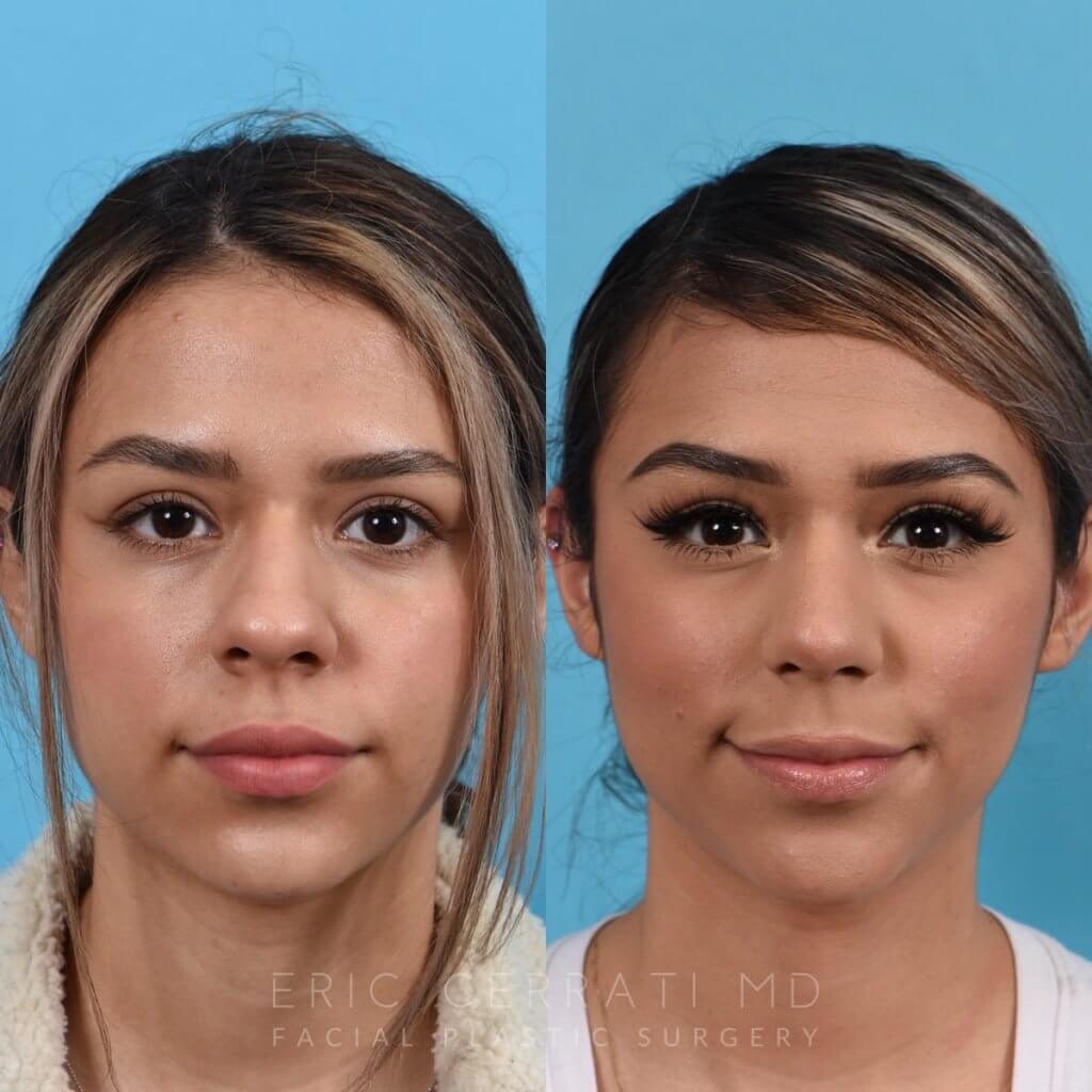 Female patient before and after rhinoplasty - front