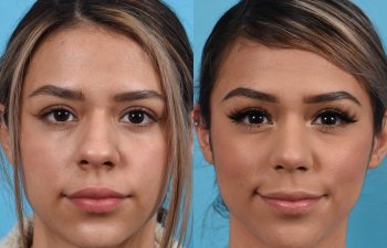 Female patient before and after rhinoplasty - front