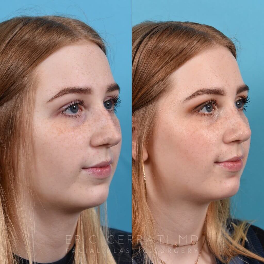 Female Patient Before and After Rhinoplasty