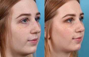 Female Patient Before and After Rhinoplasty