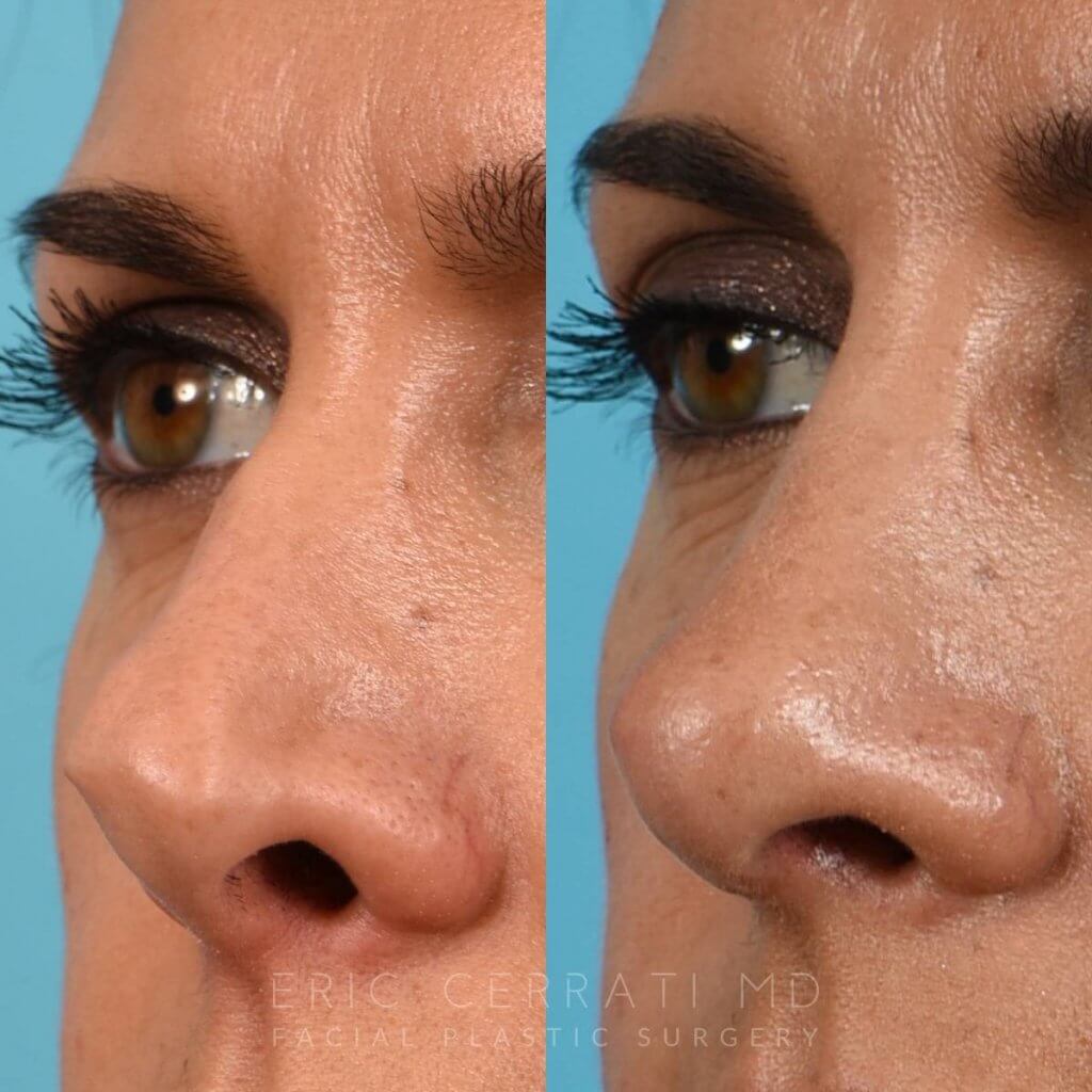 Female Patient Before and After Rhinoplasty