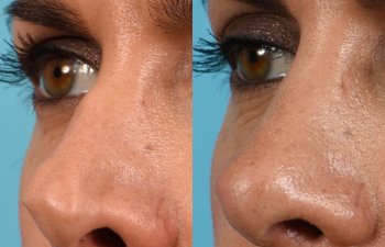 Female Patient Before and After Rhinoplasty