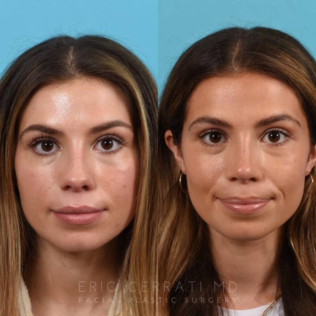 Female patient before and after rhinoplasty