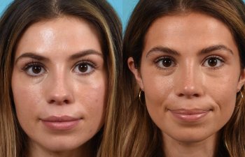 Female patient before and after rhinoplasty