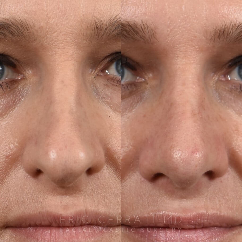 Female patient before and after rhinoplasty - front