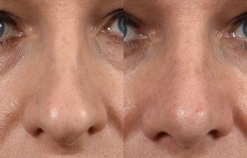 Female patient before and after rhinoplasty - front