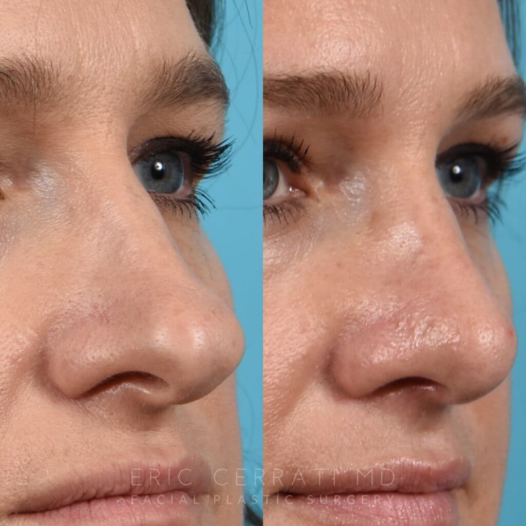 Female patient before and after rhinoplasty - right side