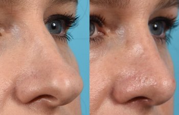 Female patient before and after rhinoplasty - right side