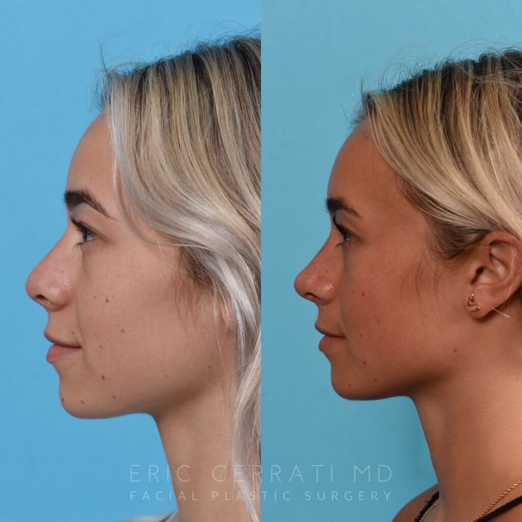 Female patient before and after rhinoplasty - left side