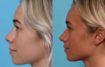 Female patient before and after rhinoplasty - left side
