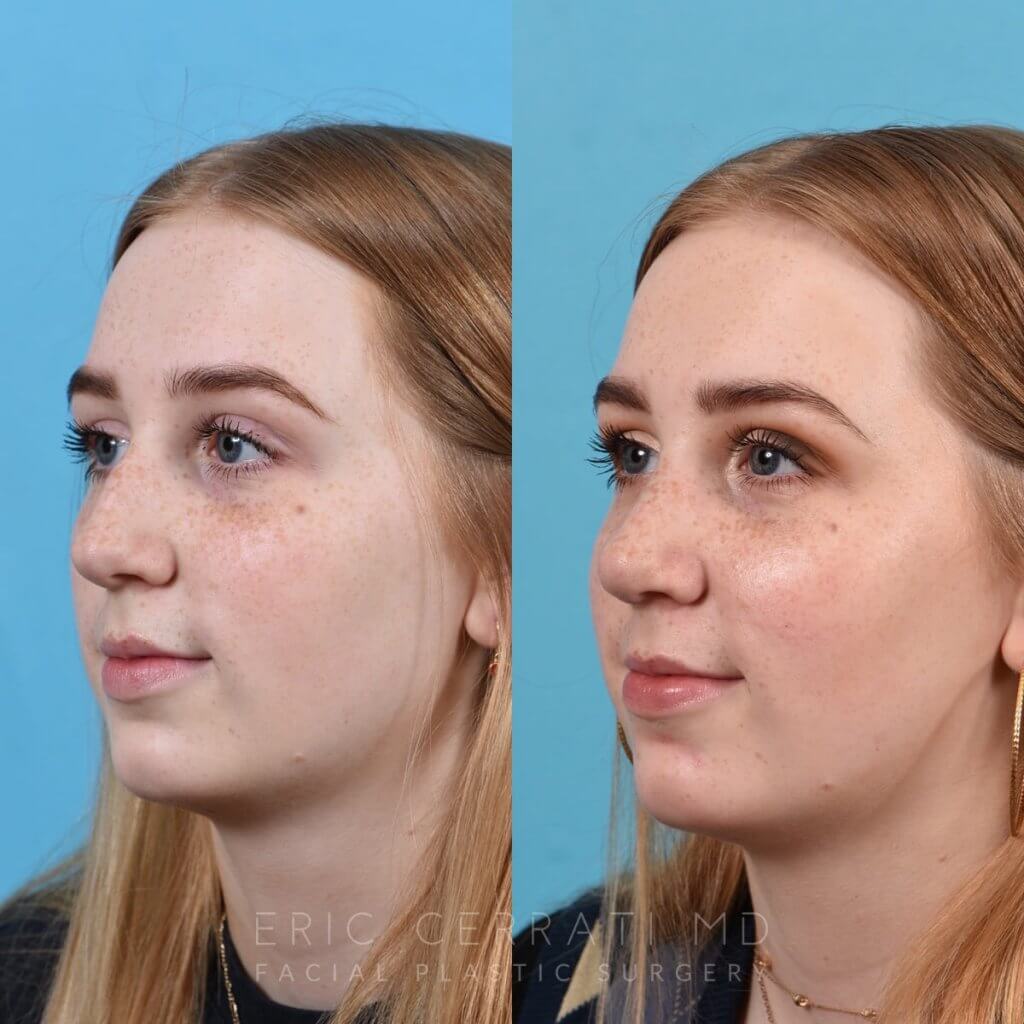 Female Patient Before and After Rhinoplasty