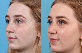 Female Patient Before and After Rhinoplasty