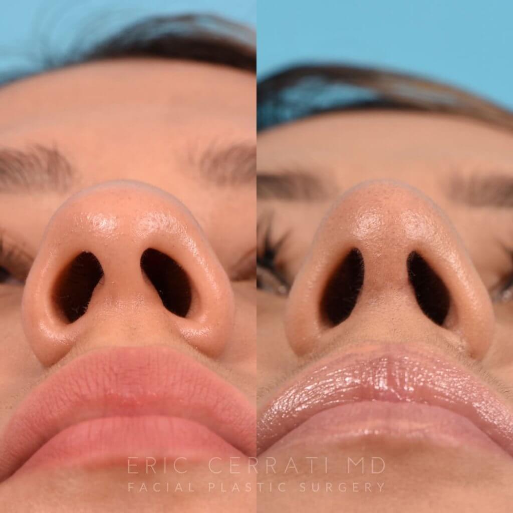 Female patient before and after rhinoplasty - front