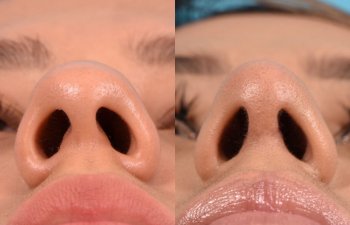 Female patient before and after rhinoplasty - front