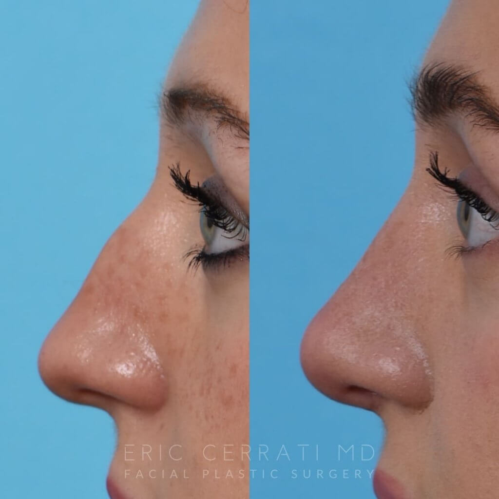 Female patient before and after rhinoplasty - left side
