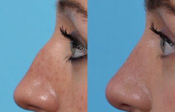 Female patient before and after rhinoplasty - left side
