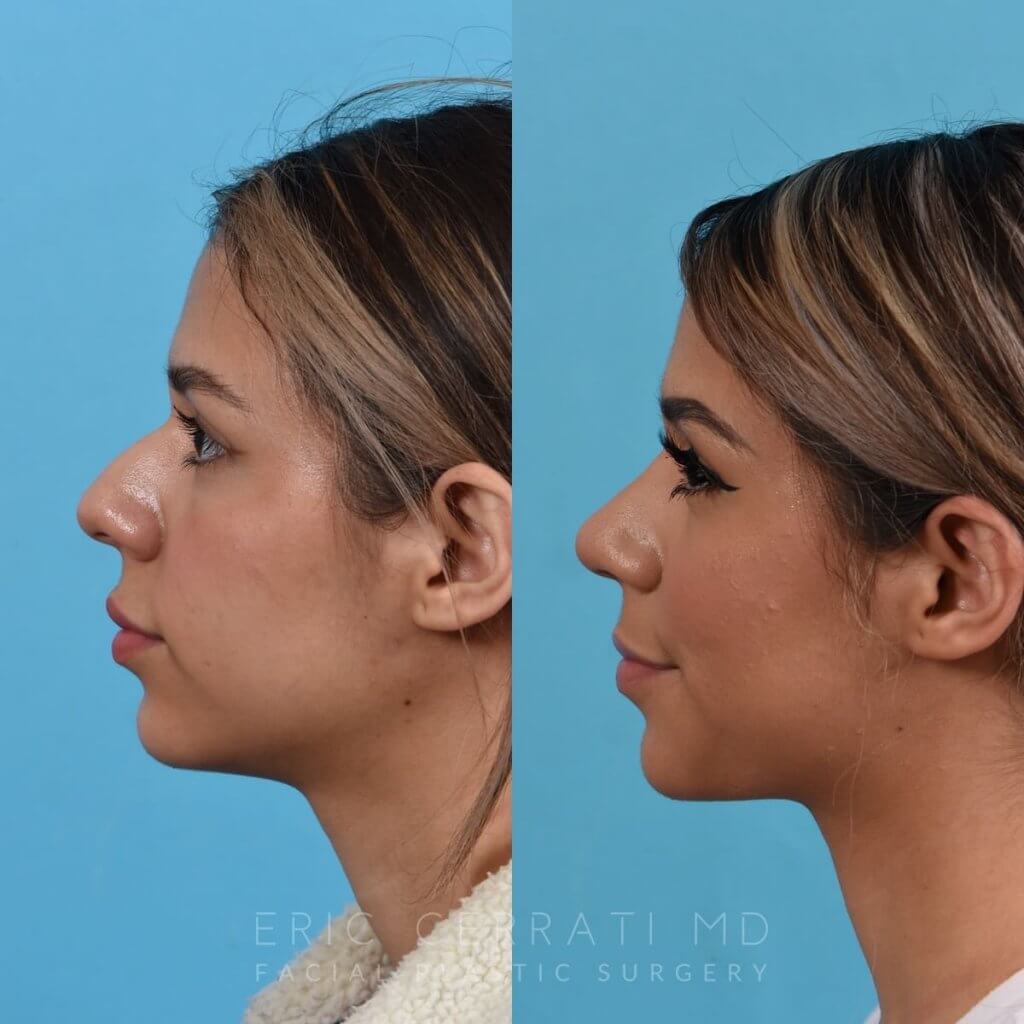 Female patient before and after rhinoplasty - left side