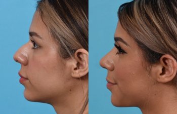 Female patient before and after rhinoplasty - left side