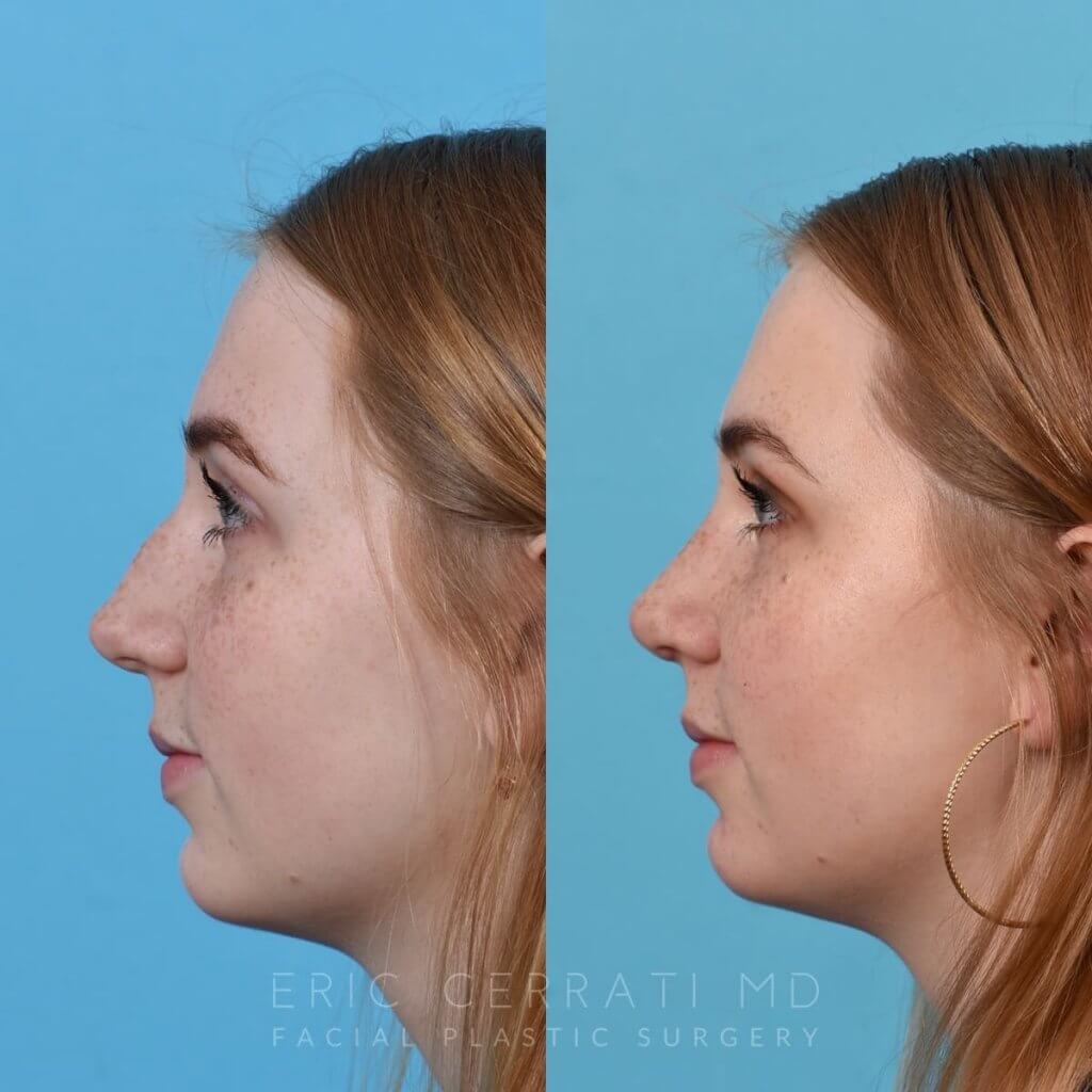 Female Patient Before and After Rhinoplasty