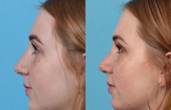 Female Patient Before and After Rhinoplasty