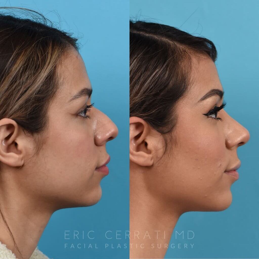 Female patient before and after rhinoplasty - right side