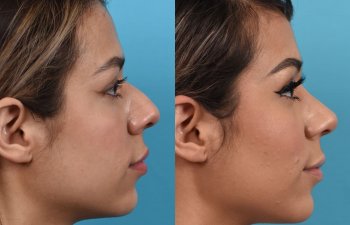 Female patient before and after rhinoplasty - right side