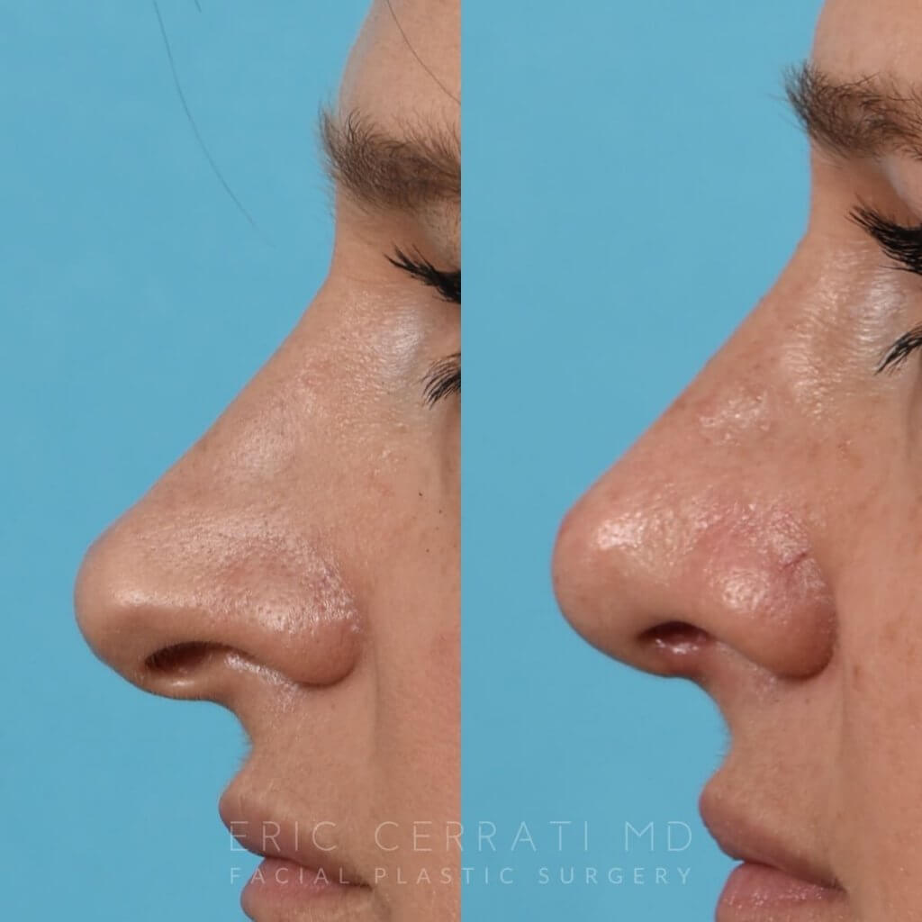 Female patient before and after rhinoplasty - left side