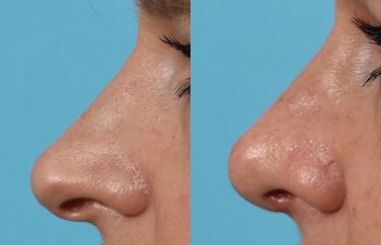 Female patient before and after rhinoplasty - left side