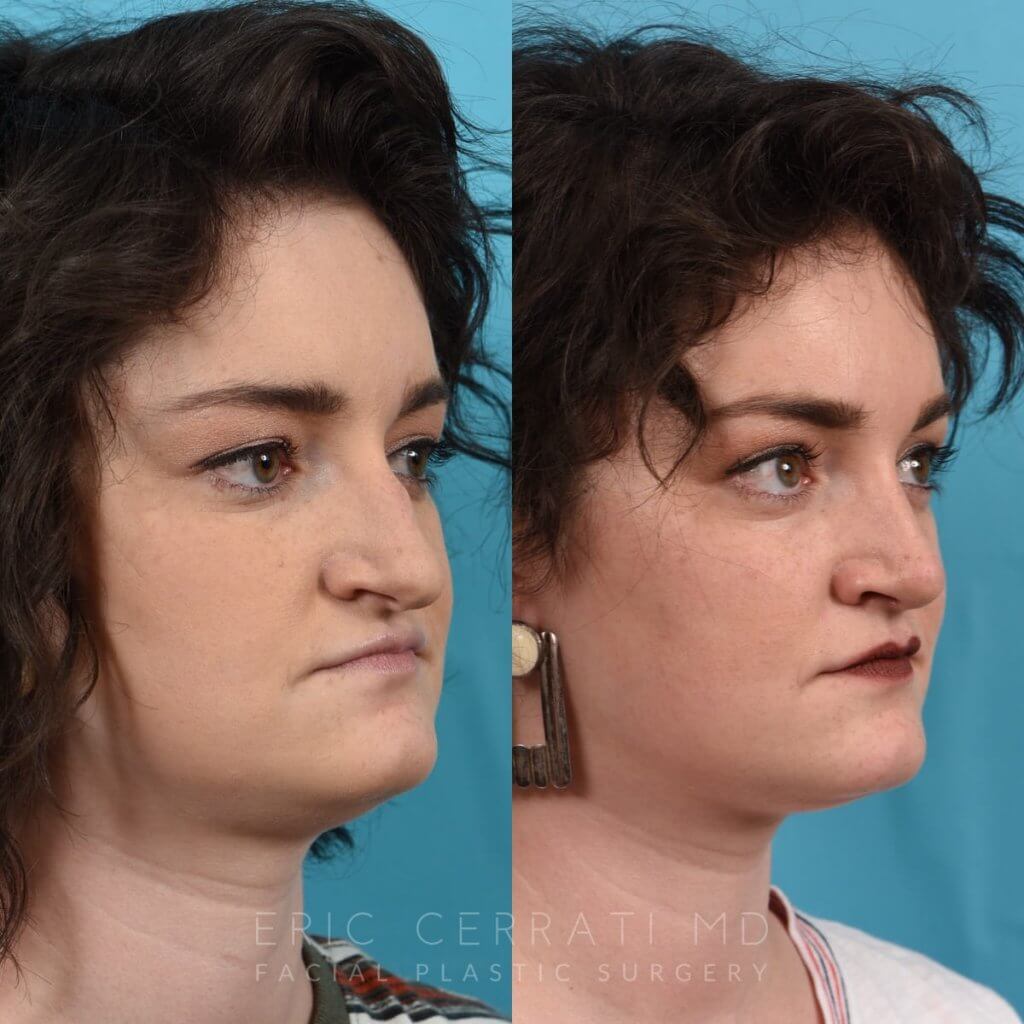 Female patient before and after rhinoplasty - right side