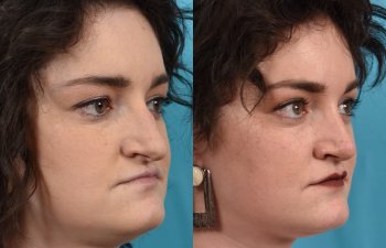 Female patient before and after rhinoplasty - right side