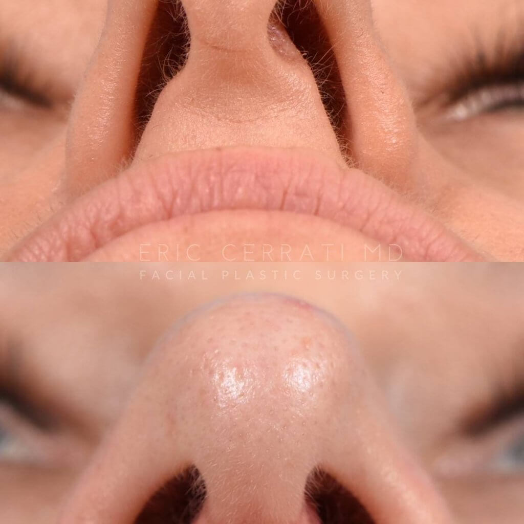 Female patient before and after rhinoplasty - front
