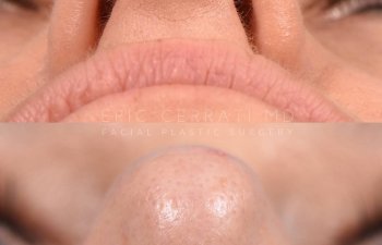 Female patient before and after rhinoplasty - front
