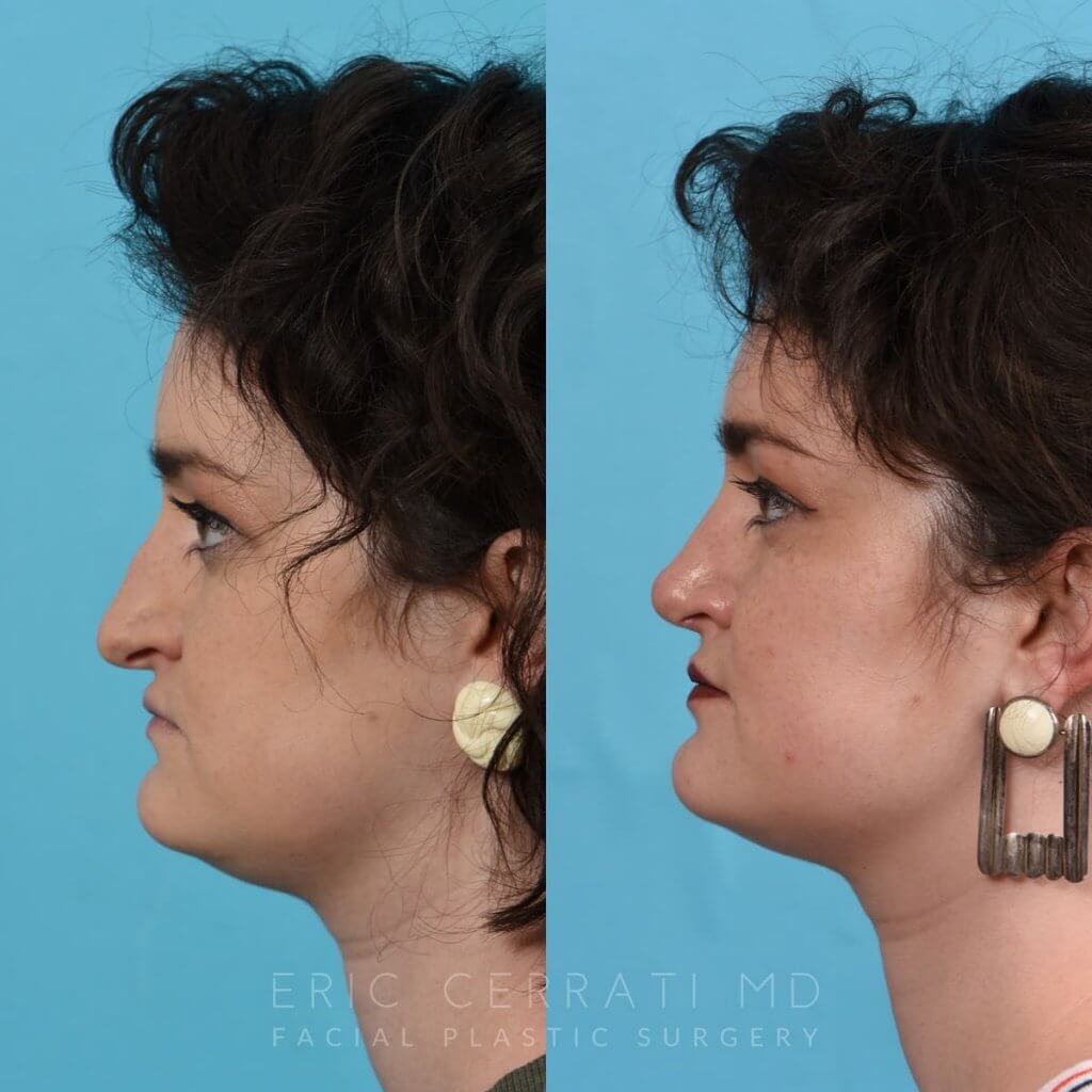 Female patient before and after rhinoplasty - left side