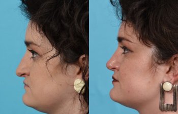 Female patient before and after rhinoplasty - left side