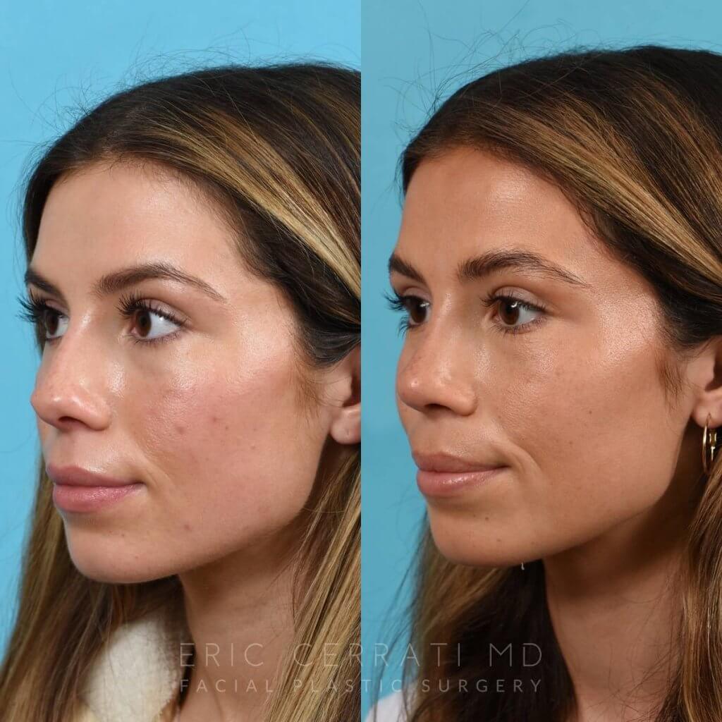 Female patient before and after rhinoplasty